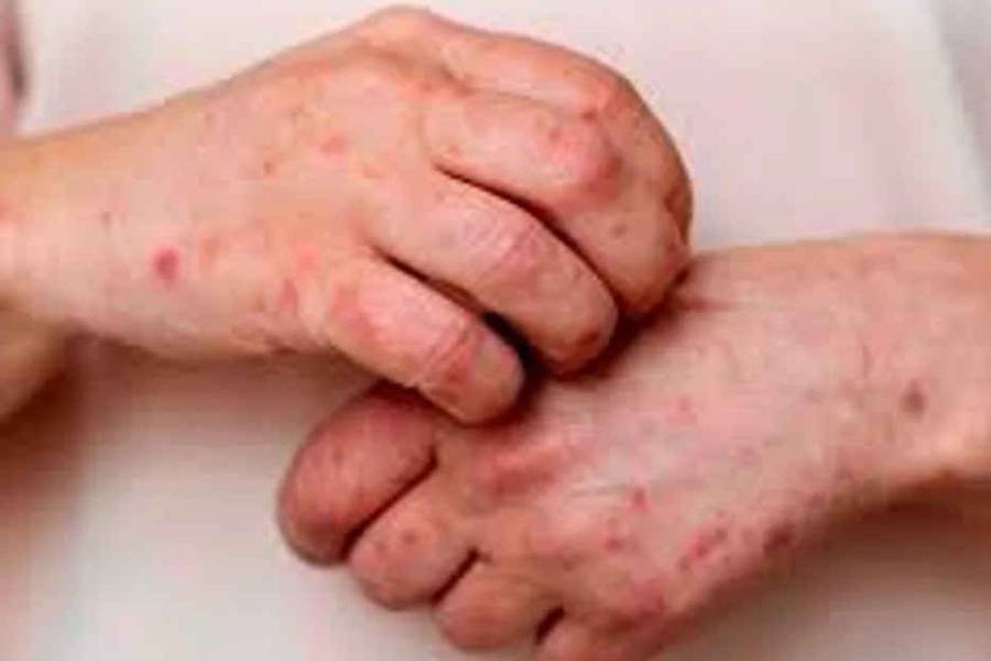 Córdoba: confirman dos nuevos casos de viruela símica