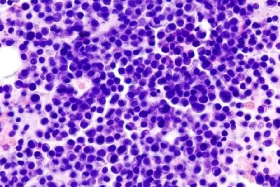 Cuál es la nueva opción de tratamiento para pacientes con mieloma múltiple aprobada por la ANMAT