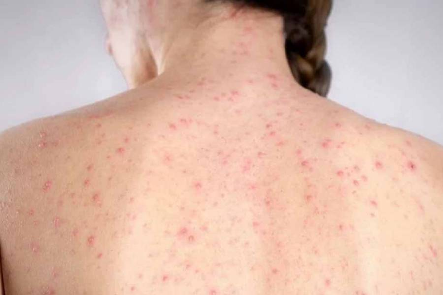 Alerta epidemiológica por nuevos casos de sarampión