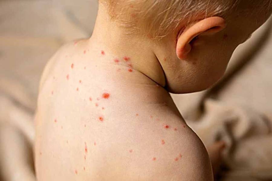 Sarampión: no se detectaron nuevos contagios y hubo provisión de vacunas