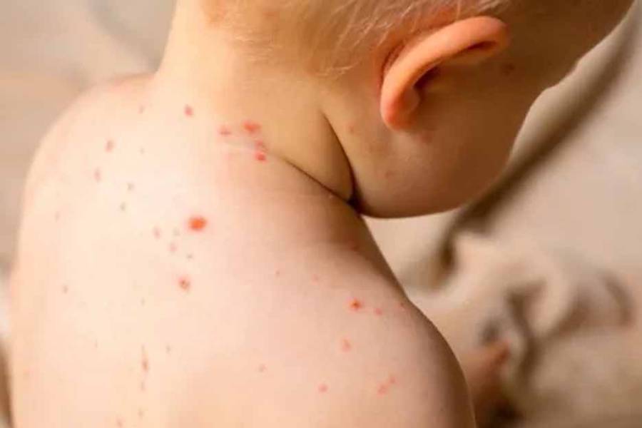 El Ministerio de Salud detectó un caso de sarampión en Entre Ríos y activó una alerta nacional