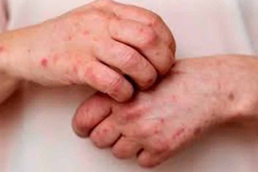 Alerta epidemiológica: confirman el primer caso de una variante más contagiosa y severa de la viruela símica