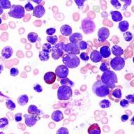 Cambió el paradigma de tratamiento de la leucemia y logran resultados inéditos