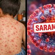Recomendaciones y medidas de prevención por el Sarampión